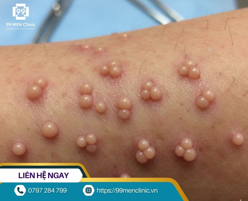 Nổi mụn thịt ở dương vật