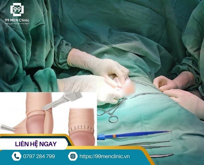 Các loại sẹo thường gặp sau khi cắt da quy đầu