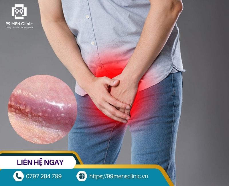 Chuỗi hạt ngọc dương vật là gì