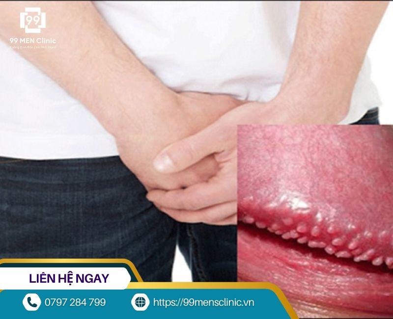 Dấu hiệu nhận biết hạt ngọc dương vật