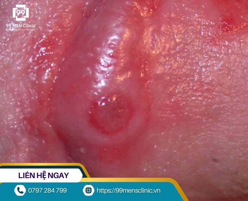 Viêm bao quy đầu gây đau rát khi quan hệ tình dục