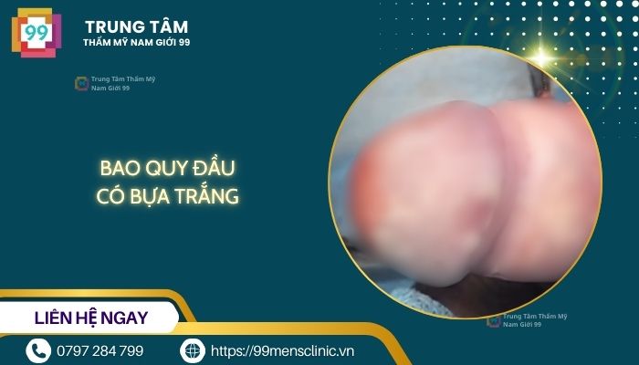Bao quy đầu có bựa trắng