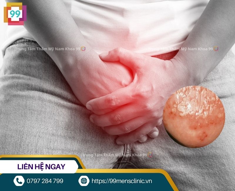 Bao quy đầu dài gây ra viêm bao quy đầu