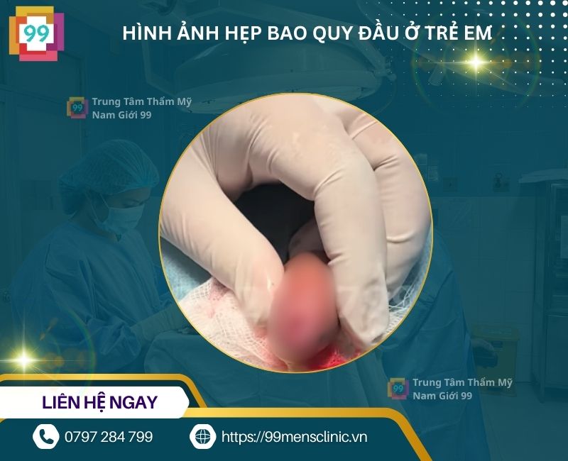 Hẹp da quy đầu ở trẻ không thể tuột xuống