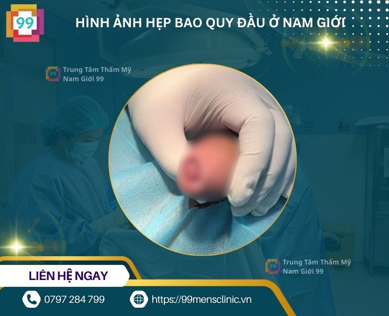 Hẹp bao quy đầu ở nam giới dẫn đến viêm
