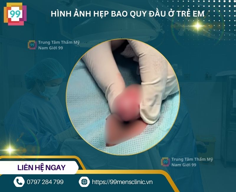 Hẹp bao quy đầu ở trẻ dẫn đến thắt ngẵn quy đầu