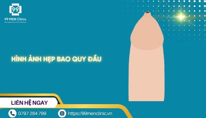 Hình ảnh hẹp bao quy đầu