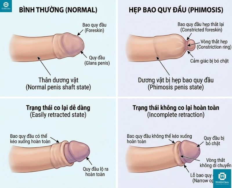 Hình ảnh so sánh trực quan giữa bao quy đầu bình thường và bao quy đầu bị hẹp