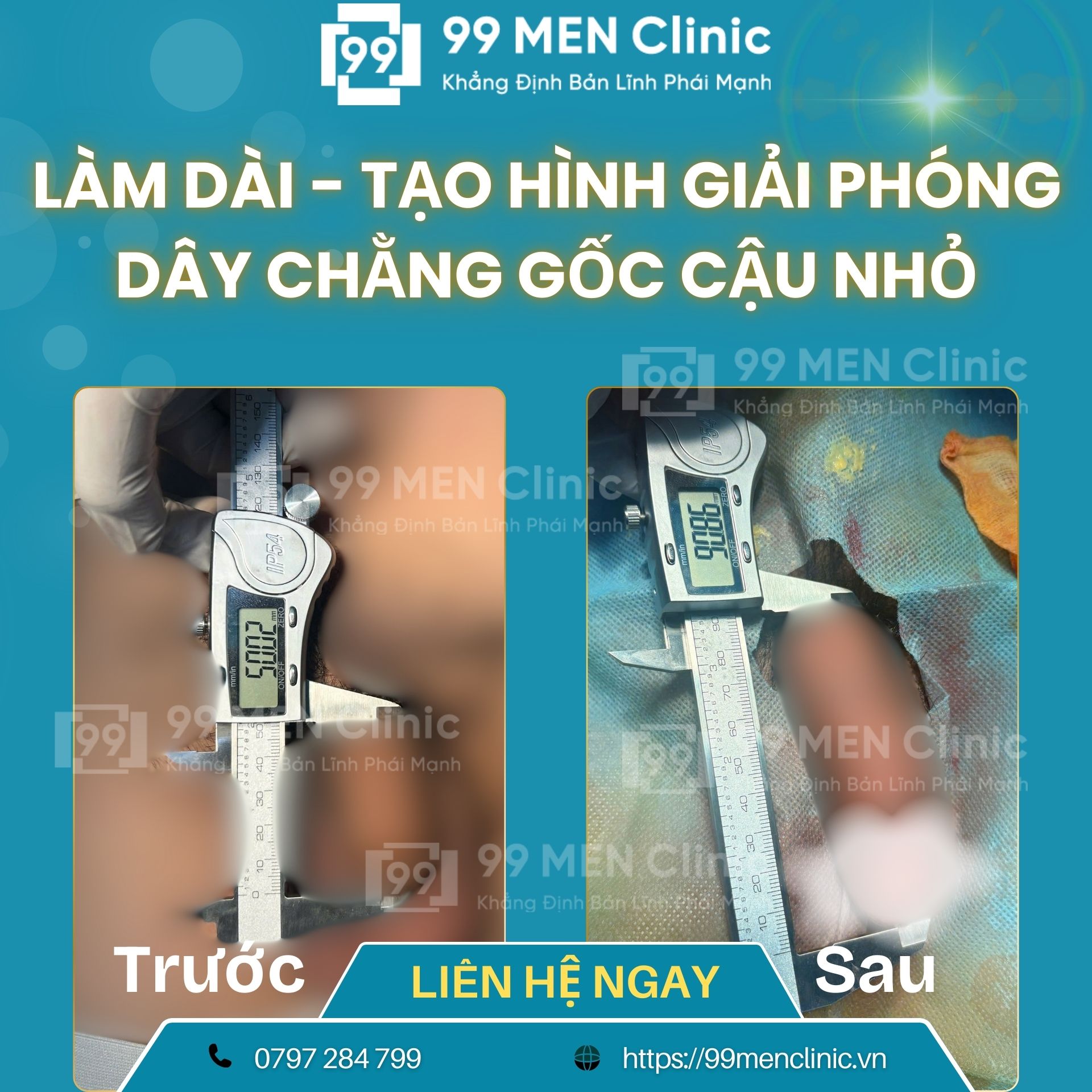 Hình ảnh sau khi làm dài dương vật