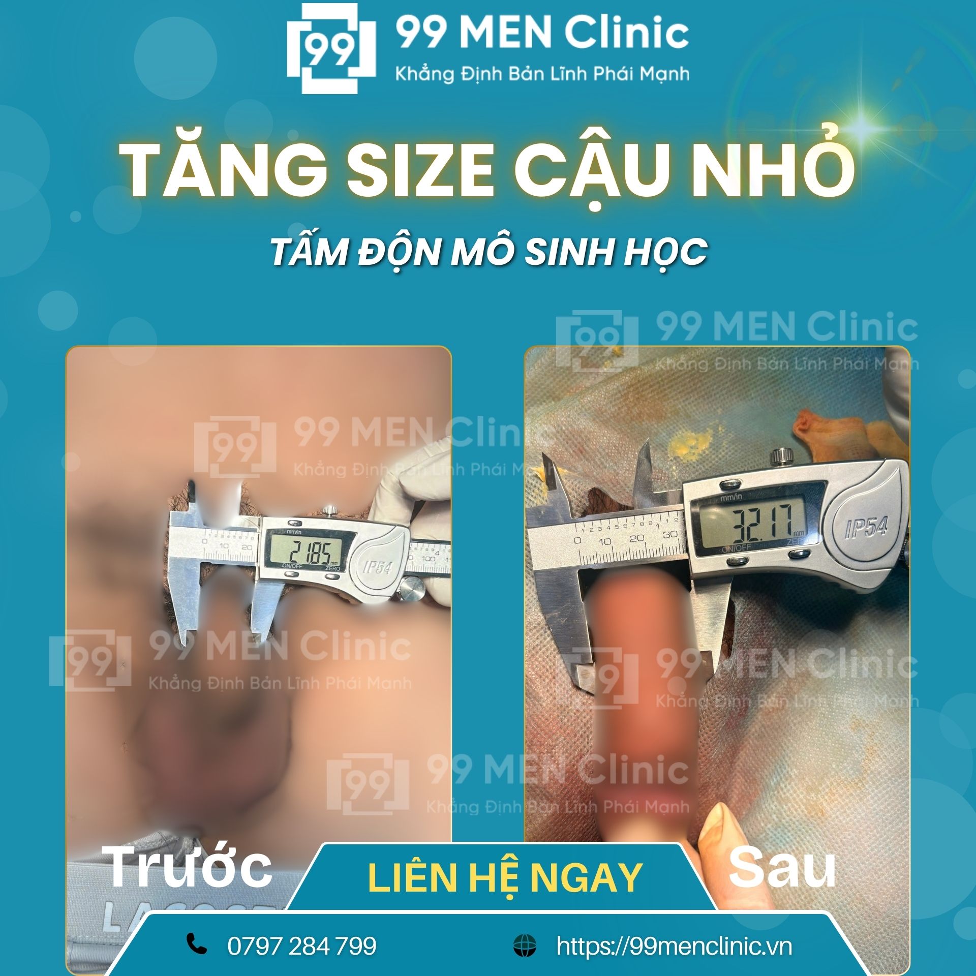 Hình ảnh tăng size dương vật sau khi phẫu thuật
