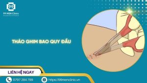 Tháo ghim bao quy đầu