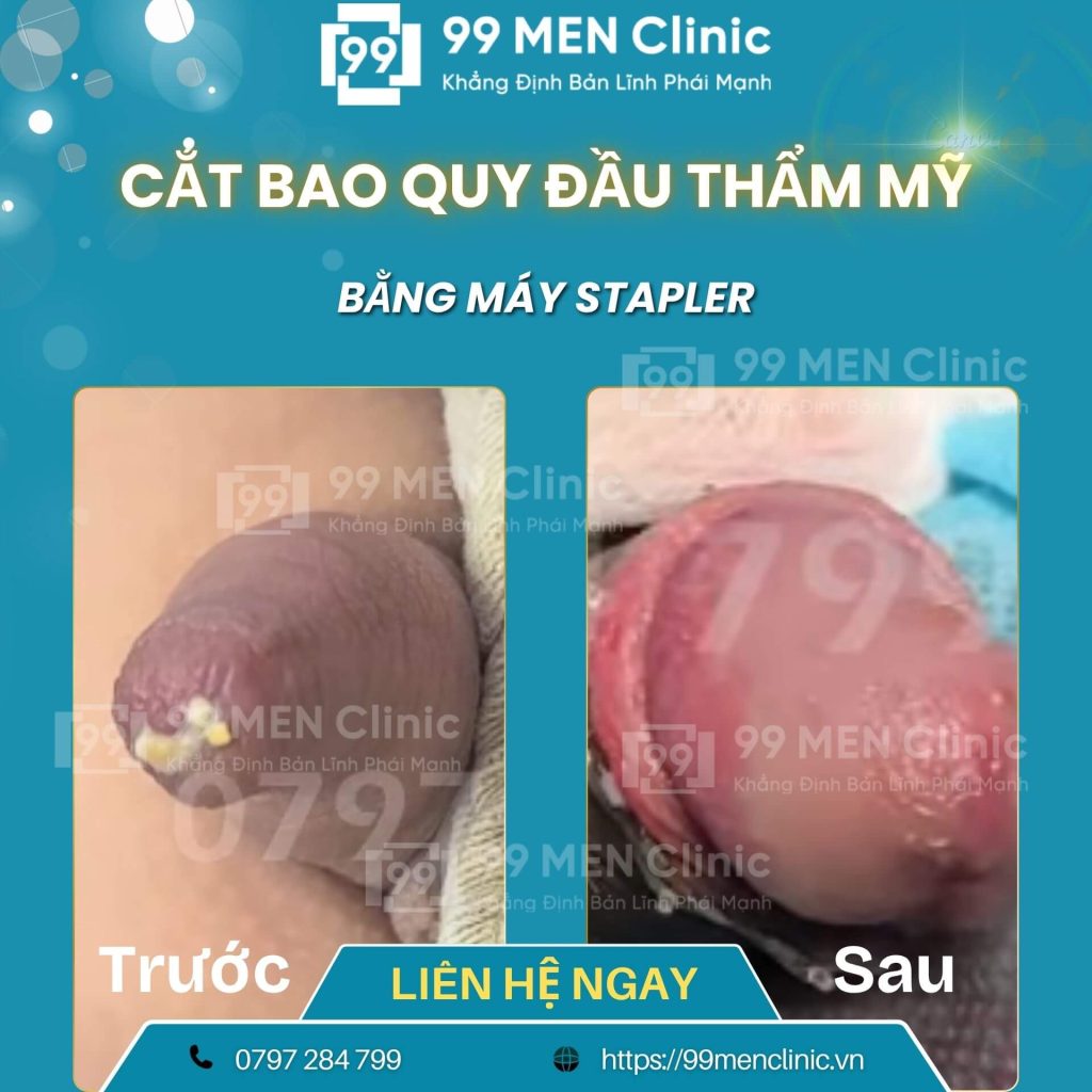 Cắt bao quy đầu bị dài