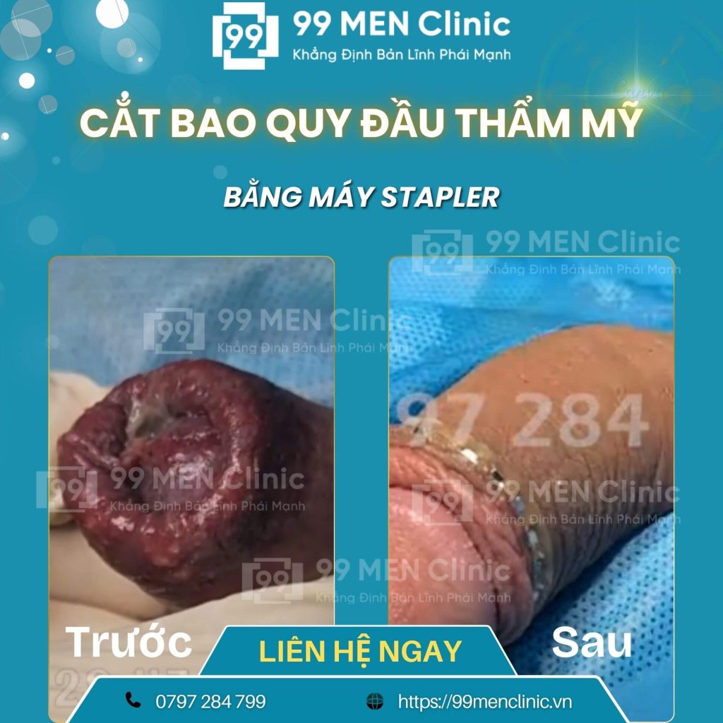 Cắt bao quy đầu bị hẹp
