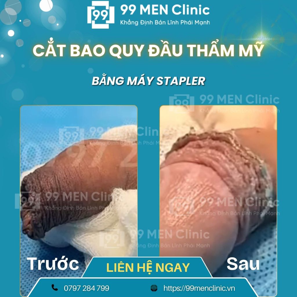 Cắt bao quy đầu bị nghẹt