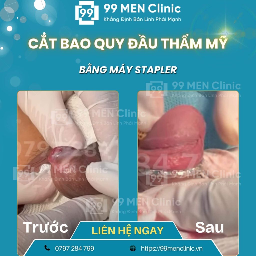 Cắt bao quy đầu bị viêm