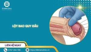Lột bao quy đầu