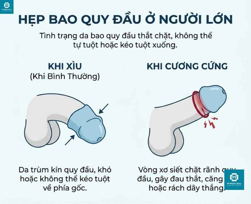 Bị hẹp bao quy đầu ở người lớn