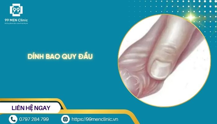 Dính bao quy đầu